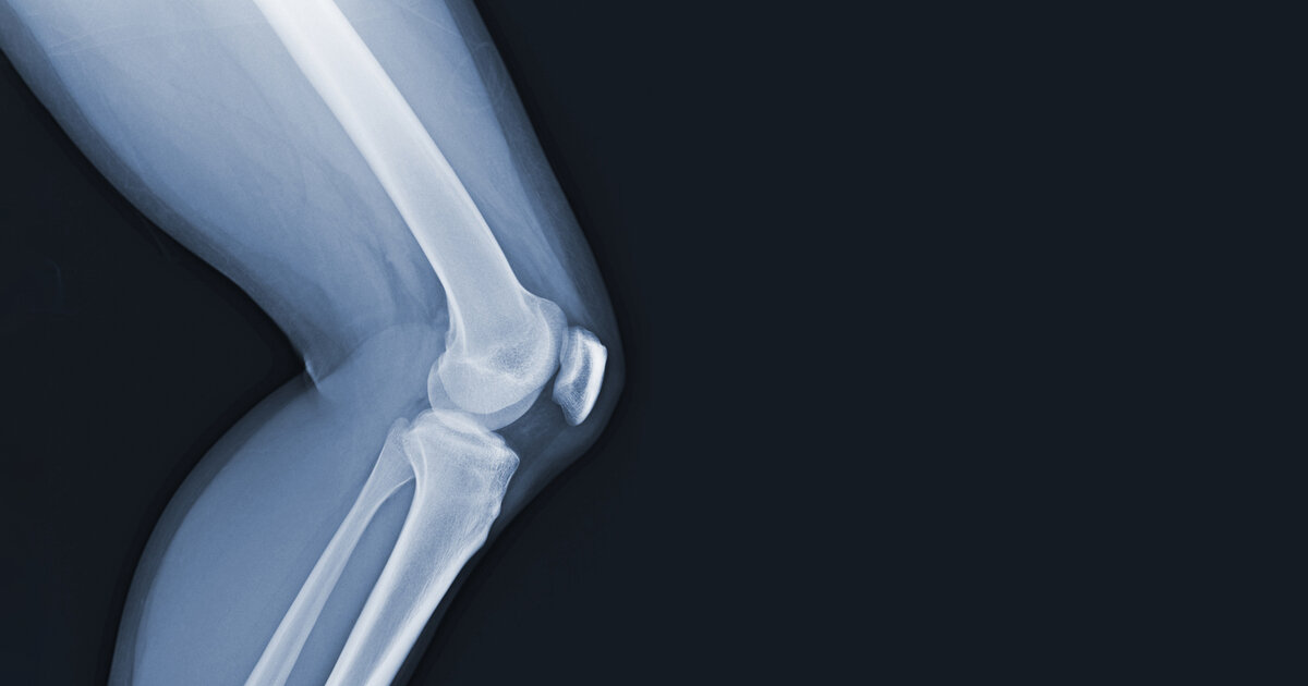 Künstliche Intelligenz erkennt Biertrinker an Knie-Röntgenbildern – und liegt voll daneben